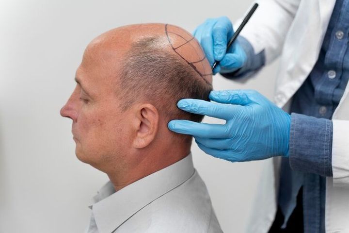 Hair Transplants: A Clear and Comprehensive Guide